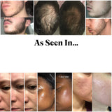 0.2–0.3mm Derma Roller – Microneedle Tool for Facial Skin & Beard Growth